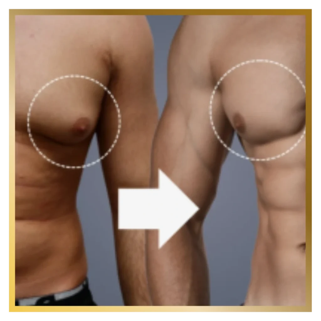 Gynecomastia glojas