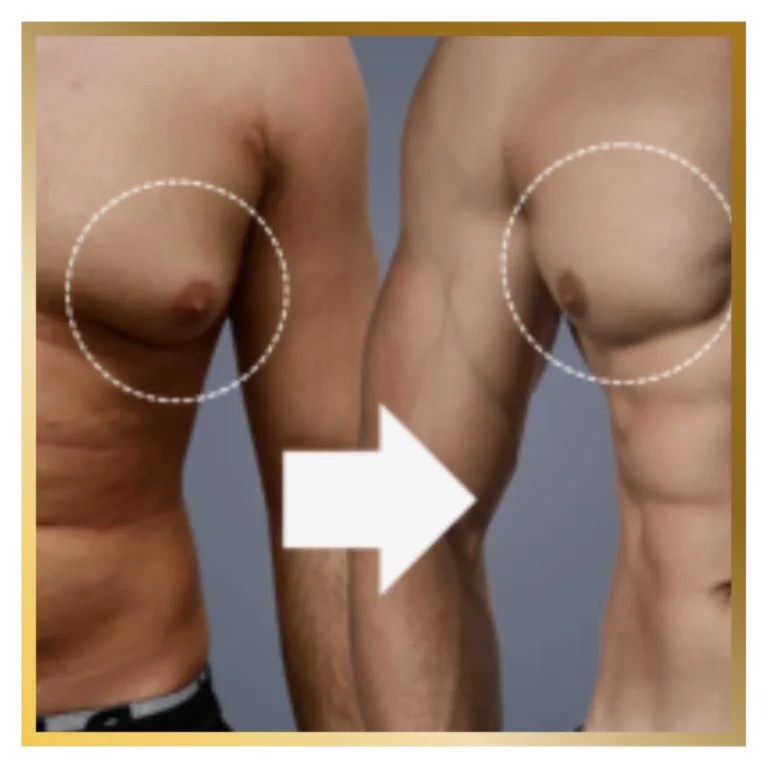 plastic-surgery-malaysia-reconstructive-surgeon-gynecomastia