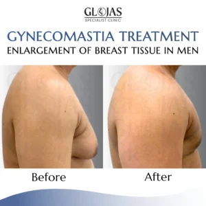 plastic-surgery-malaysia-before-after-gynecomastia-3