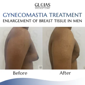 LANDING PAGE GYNECOMASTIA 111 05