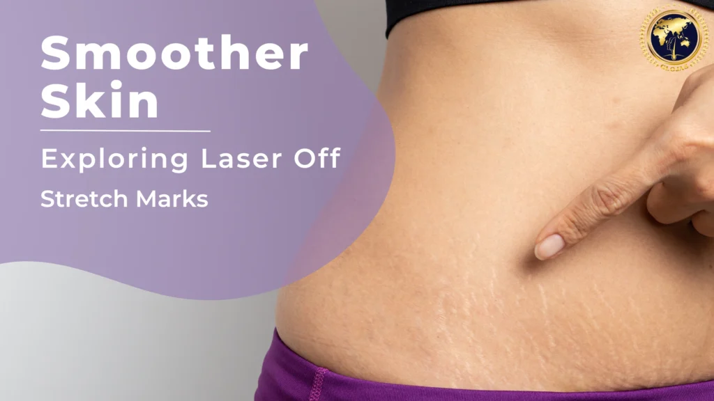 Laser Off Stretch Marks