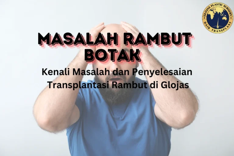 Masalah Rambut Botak