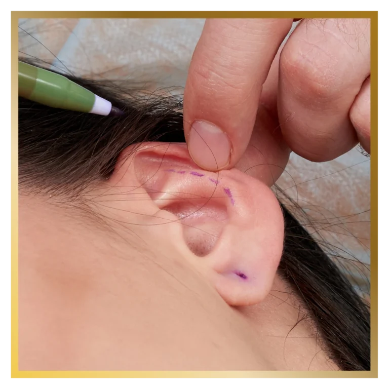 plastic-surgery-malaysia-reconstructive-surgeon-otoplasty