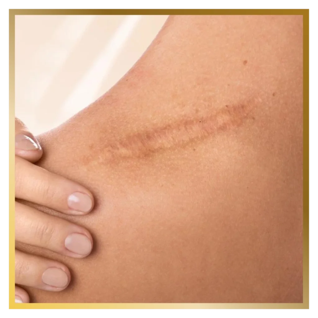 Scar Removal