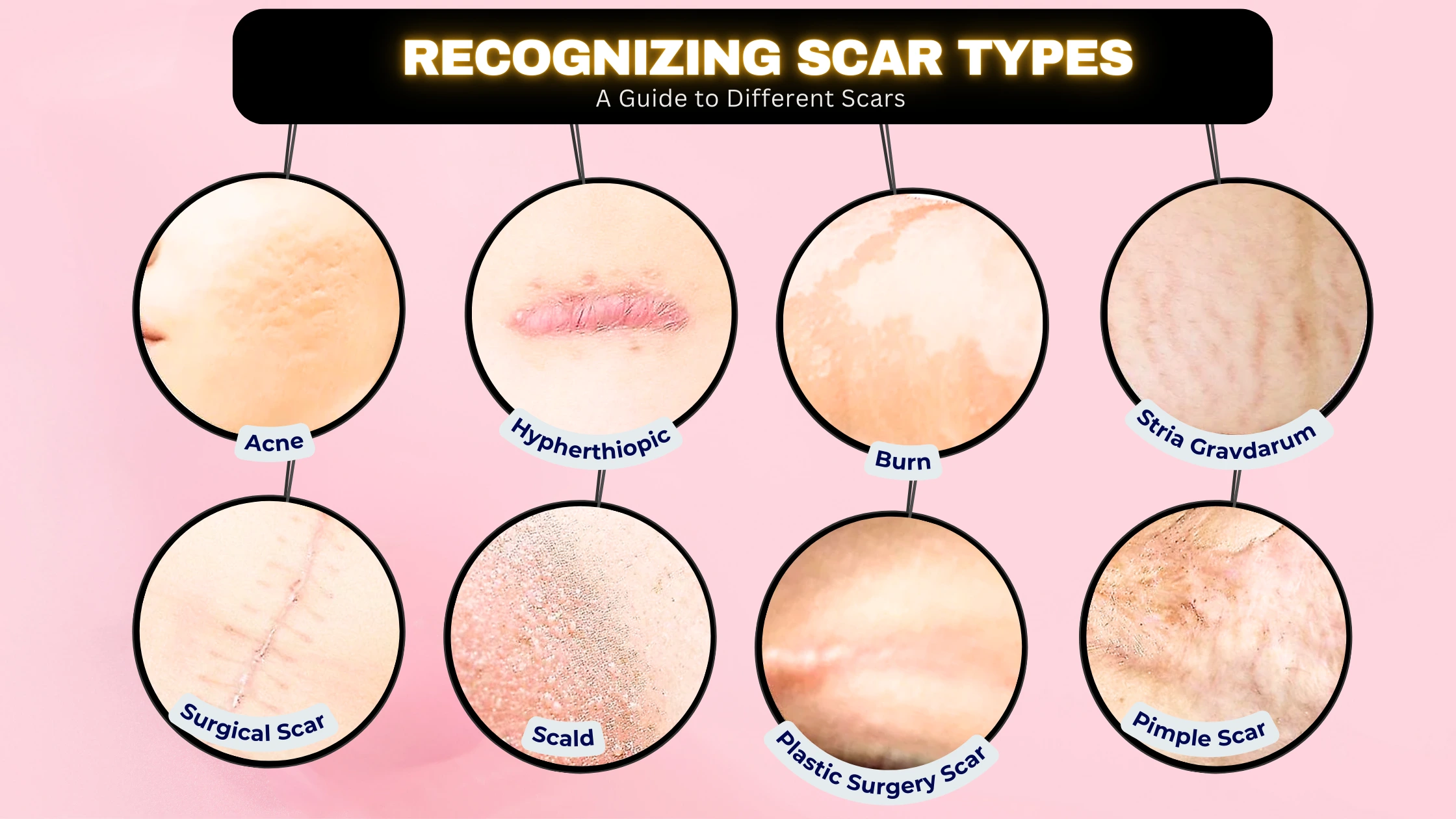 Scar Types