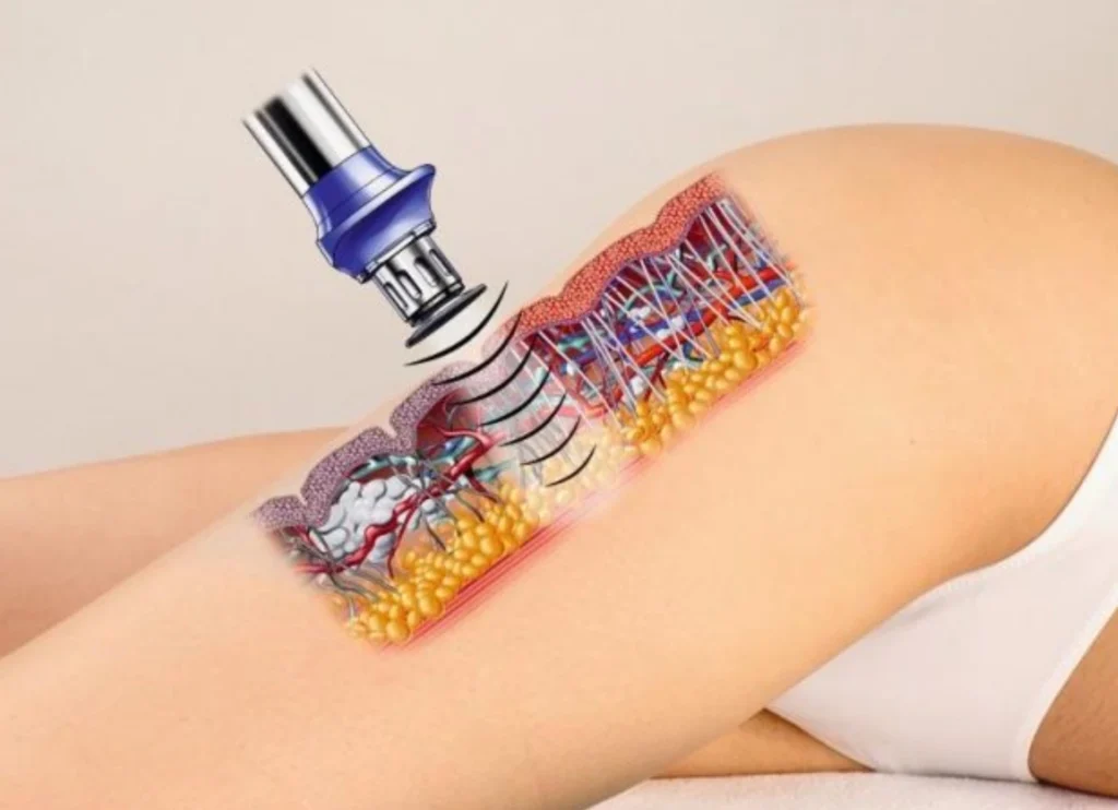 Shockwave Therapy (X Wave)