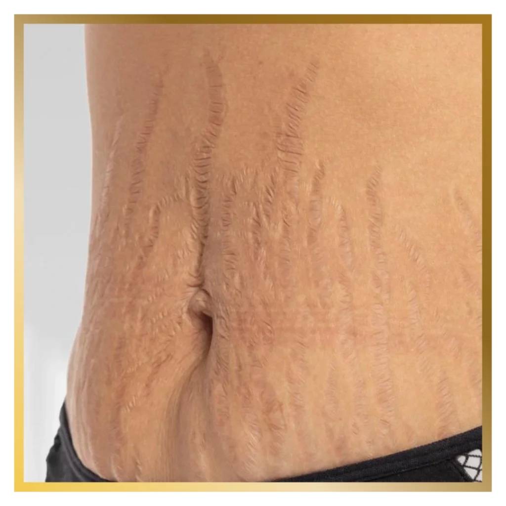 Stretch Mark & Cellulite Treatment