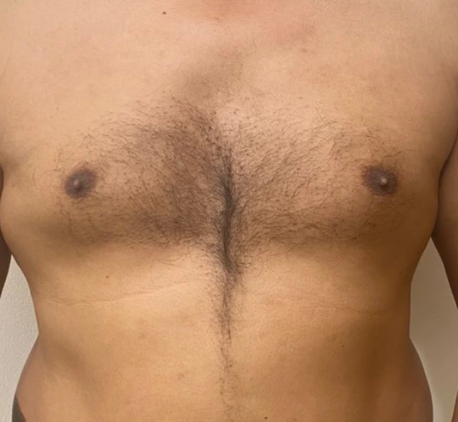 chest-hair-transplant-after