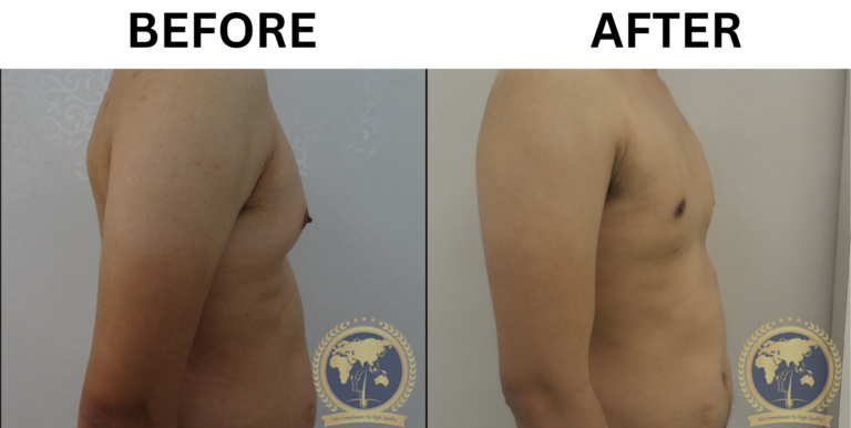 gynecomastia surgery before and after 2