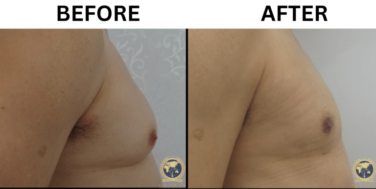 gynecomastia surgery before and after 3