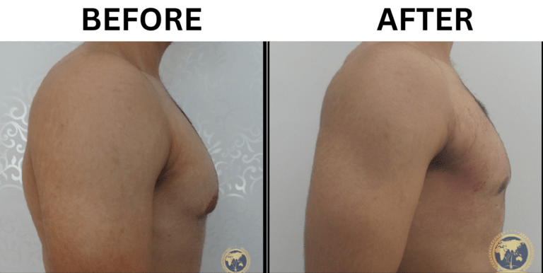 gynecomastia surgery before and after 4