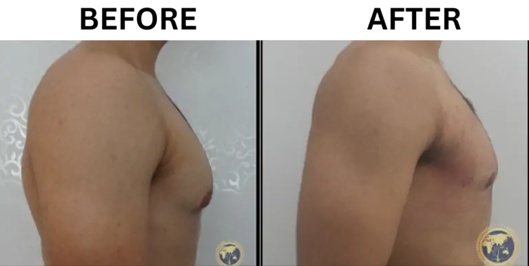 gynecomastia surgery before and after 4