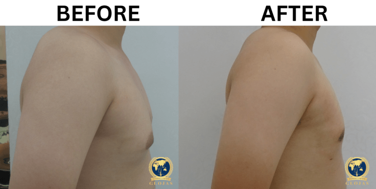 gynecomastia surgery before and after 7