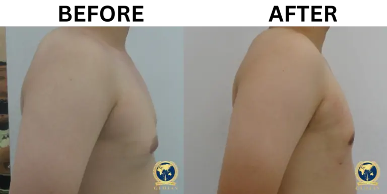 gynecomastia surgery before and after 7