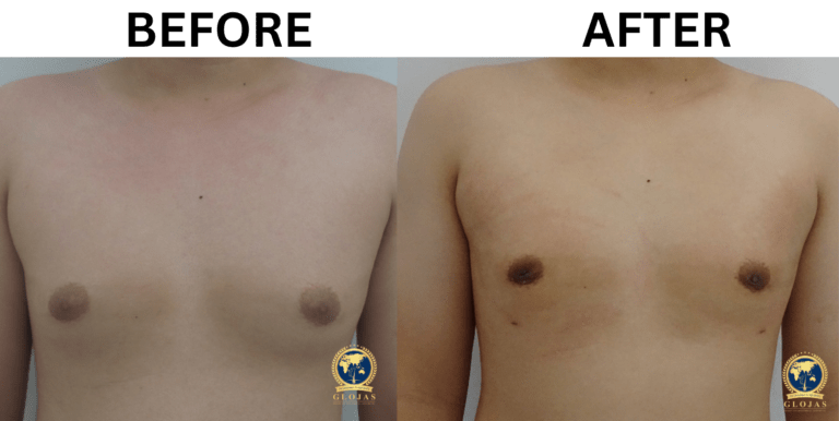 gynecomastia surgery before and after 8