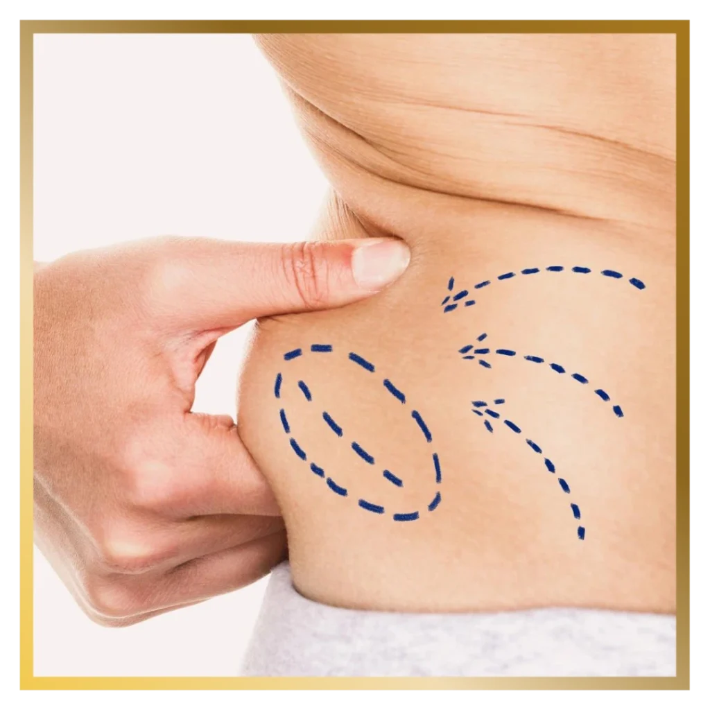 liposuction glojas