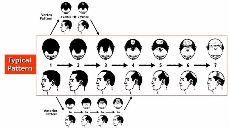 hair-loss-pattern-typical-malaysia-hair-transplant