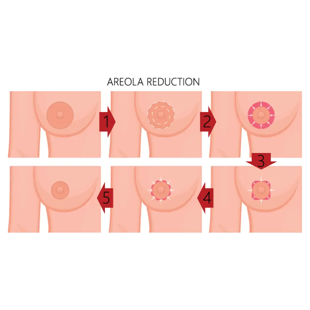 Areola-Reduction-malaysia