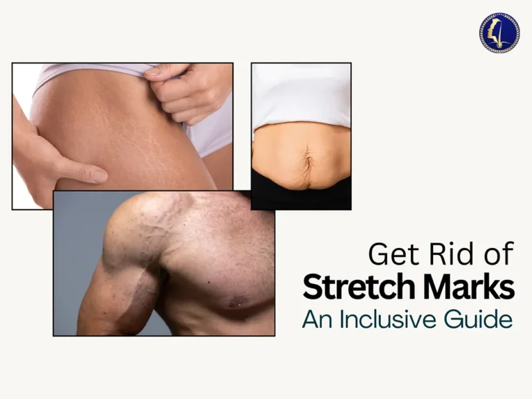 how-to-get-rid-of-stretch-marks-aesthetic-clinic