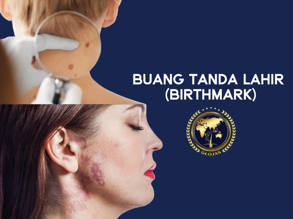 buang-tanda-lahir-klinik,bbuang-tanda-lahir-malaysia,buang-tanda-lahir-glojas