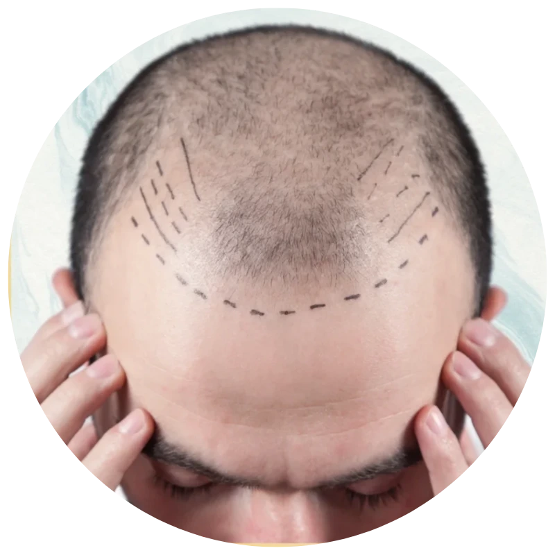 hair-transplant-malaysia