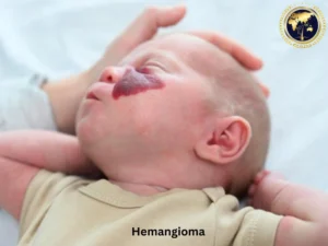 Hemangioma