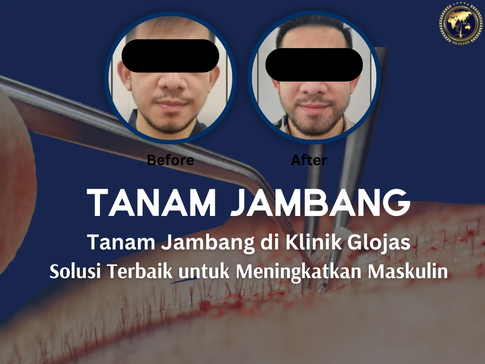 tanam-jambang-klinik, tanam-jambang-malaysia,tanam-jambang-glojas