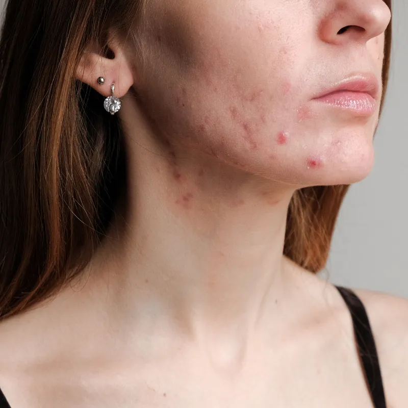 acne-aesthetic-clinic-malaysia-glojas