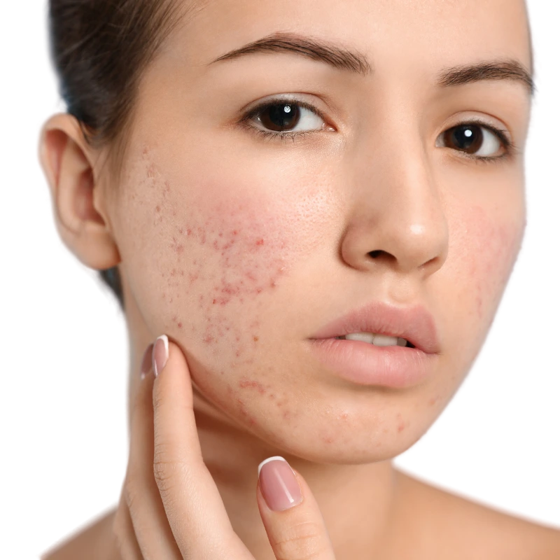 acne-medication-protocol-aesthetic-clinic-malaysia-glojas