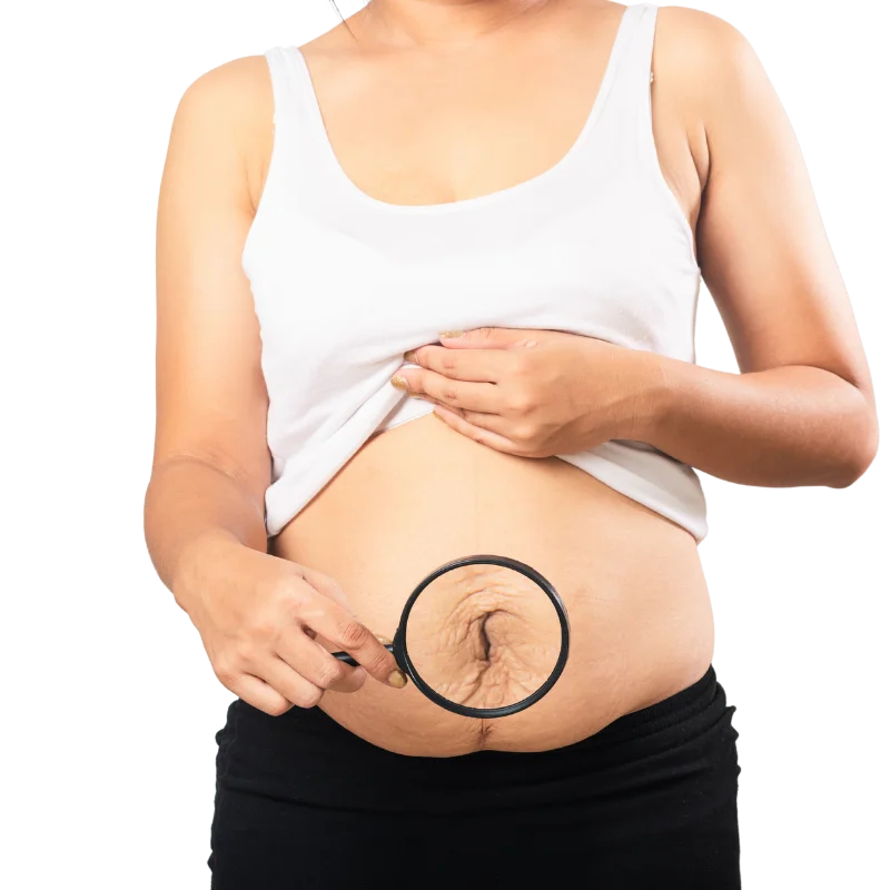 aesthetic-clinic-malaysia-pregnancy-stretch-marks-Vanquish