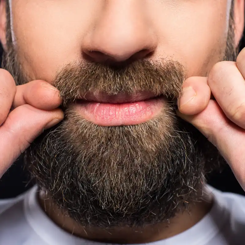 beard-transplant-malaysia