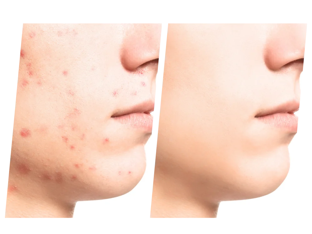 black-pimples-on-face-subcision-aesthetic-clinic-malaysia-01