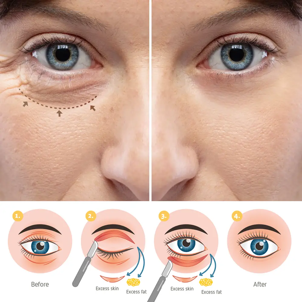 blepharoplasty-malaysia