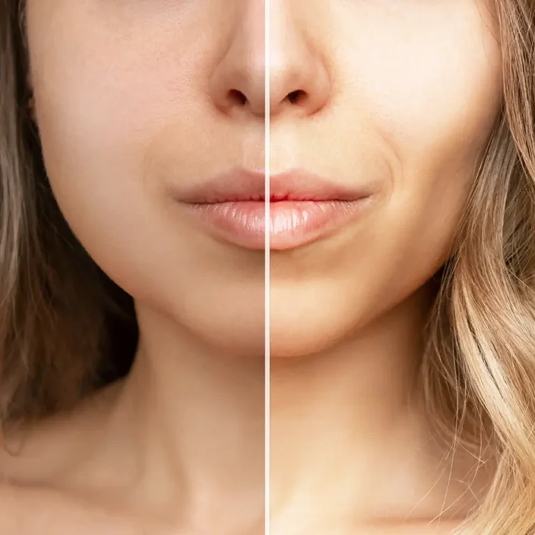 Buccal Fat Removal Surgery for Natural-Looking Slimmer, Sculpted Cheeks