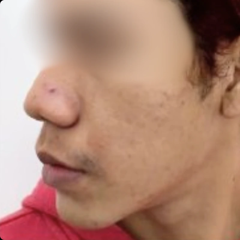 chemical-peel-after