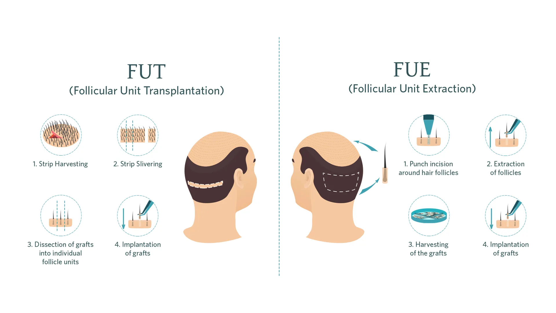 faq-beard-hair-transplant