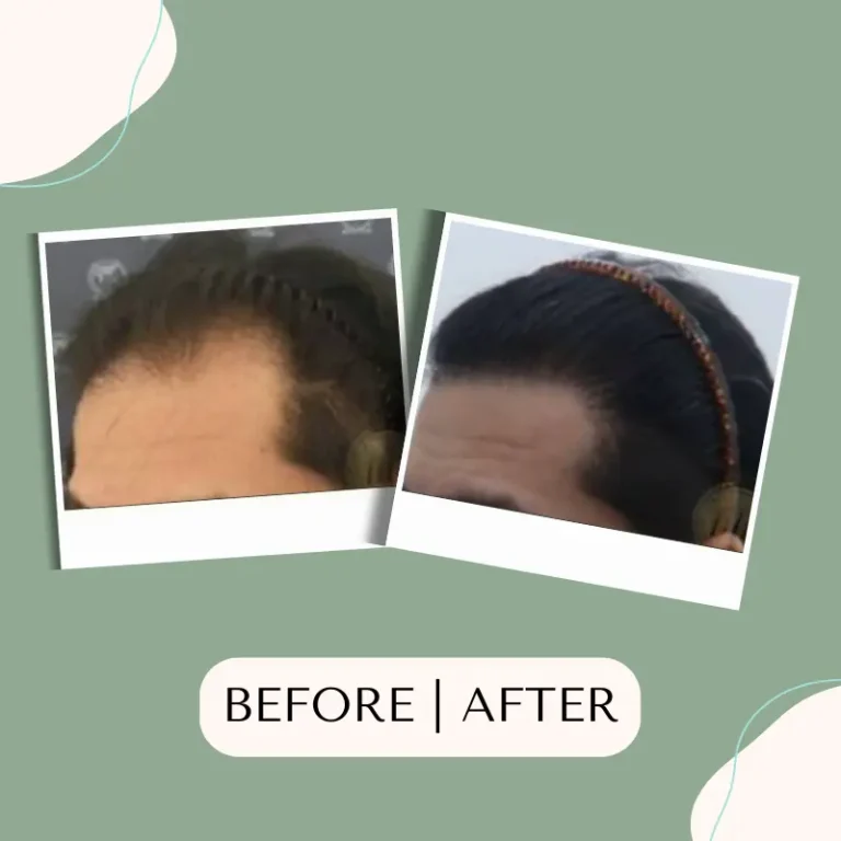 hair-transplant-glojas-hair-transplant-malaysia-specialist