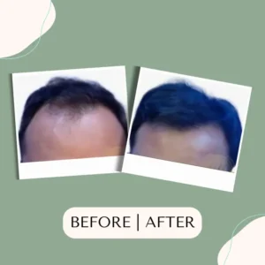 hair-transplant-glojas-hair-transplant-malaysia-specialist-1