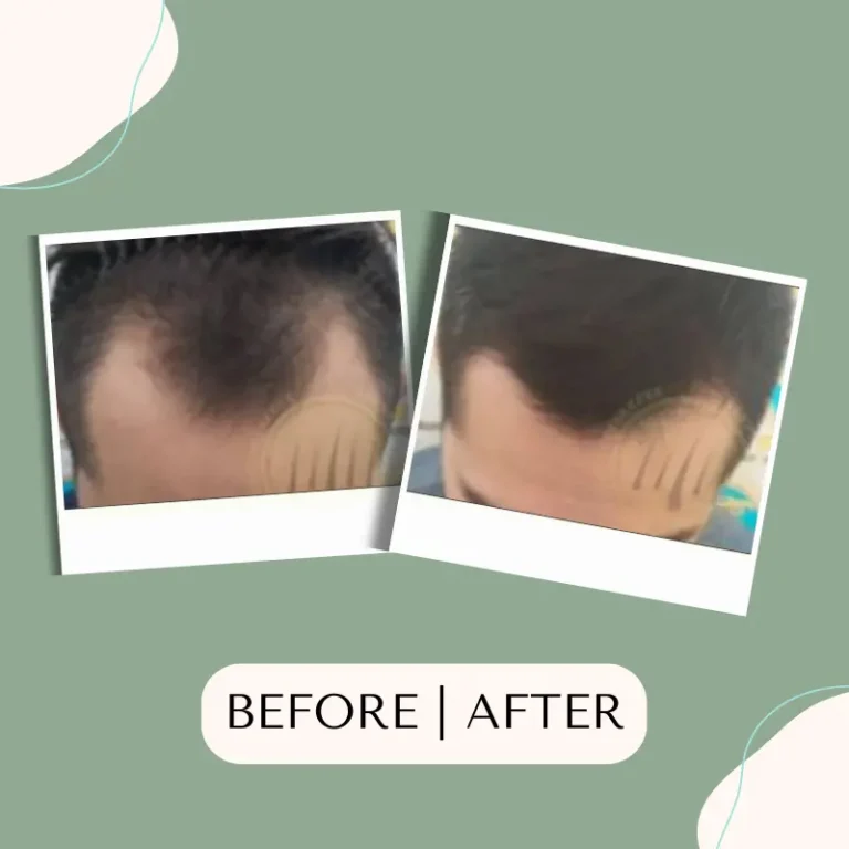 hair-transplant-glojas-hair-transplant-malaysia