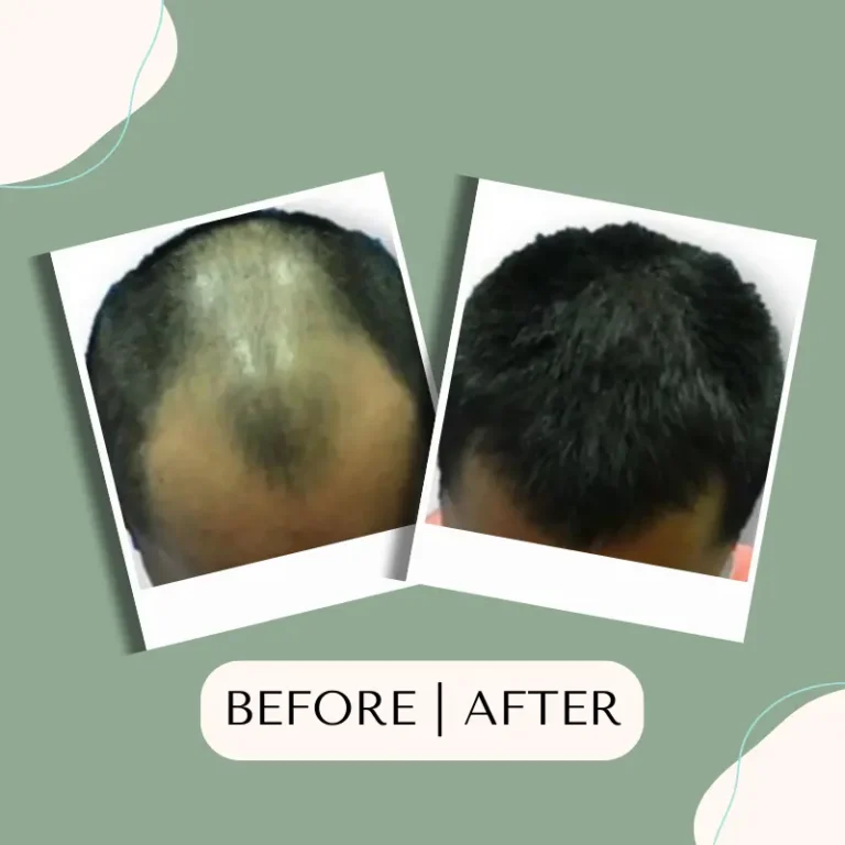 hair transplant glojas hair transplant malaysia 005