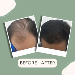 hair-transplant-glojas-hair-transplant-malaysia