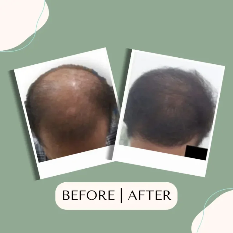 hair-transplant-glojas-hair-transplant-malaysia