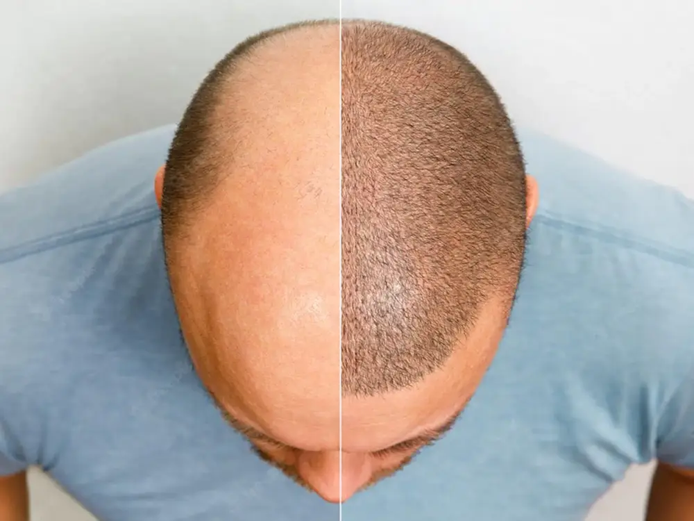 hair-transplant-malaysia-fue-glojas-1