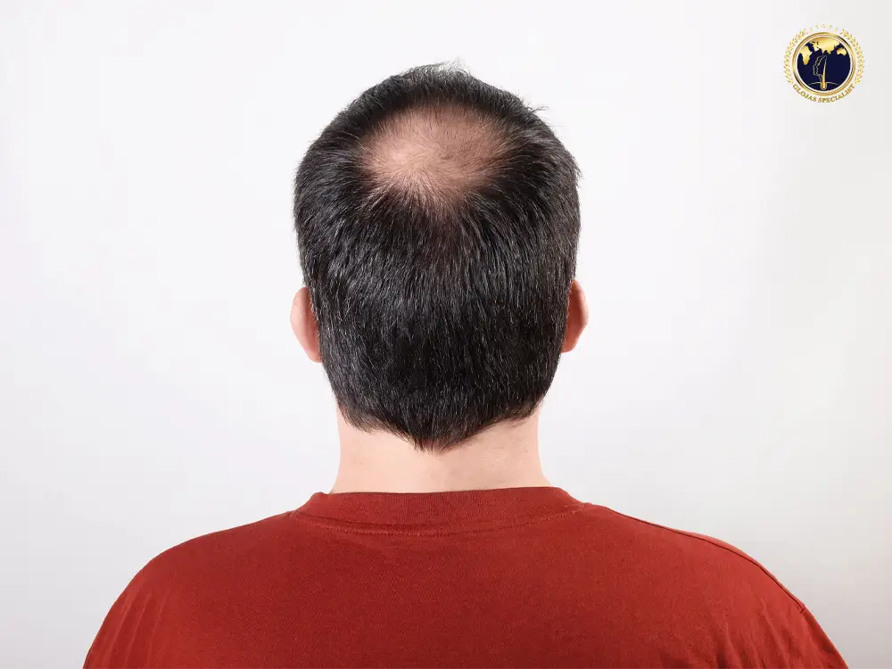 fue-hair-transplant-malaysia-hair-lost-men