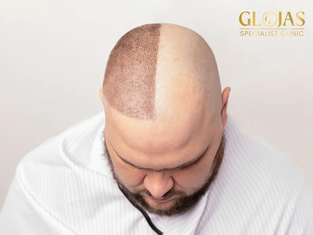 hair-transplantation