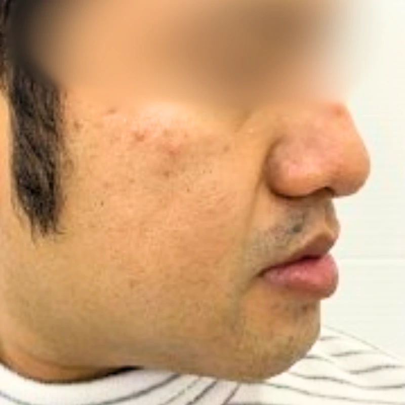 hyperpigmentation-treatment-after