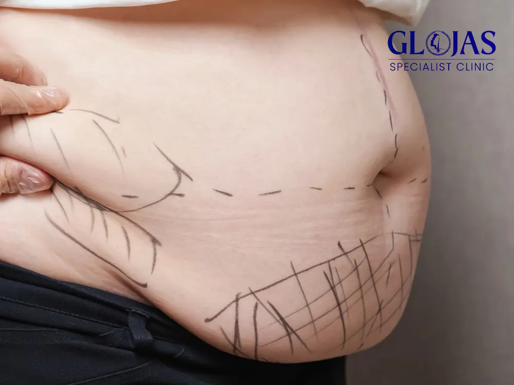 liposuction