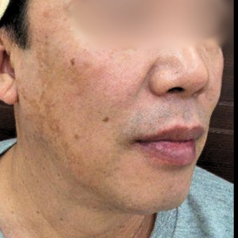 pigmentation-treatment-before