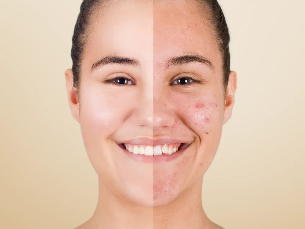 post-inflammatory-hyperpigmentation-malaysia-microdermabrasion