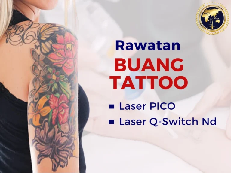 buang-tattoo-klinik,buang-tattoo-malaysia,buang-tattoo-glojas